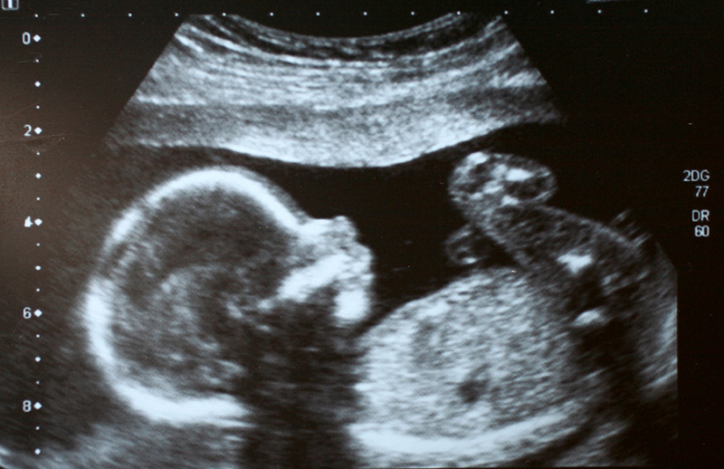 Ultrasound image of fetus.