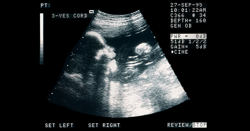 An ultrasound image of a fetus.
