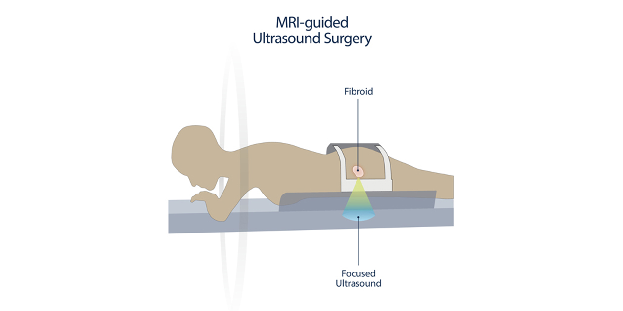 A patient undergoing MRI-guided ultrasound surgery lies face down in an MRI scanner. A fibroid and an ultrasound focused on the patient’s abdomen are labeled.