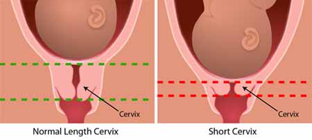 Graphic showing a normal size cervix and a short cervix.