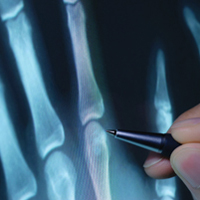 x-ray of bones in hand