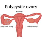 Women’s reproductive organs, with uterus and ovaries labeled. One ovary is deformed by cysts and labeled polycystic ovary; the other is normal and labeled healthy ovary. 