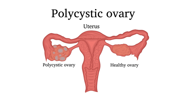 Women’s reproductive organs, with uterus and ovaries labeled. One ovary is deformed by cysts and labeled polycystic ovary; the other is normal and labeled healthy ovary. 
