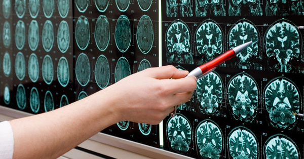 Image of pen pointing to brain scans on a wall