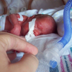 Premature infant on ventilator