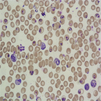Red blood cells infected with malaria parasites (purple).
