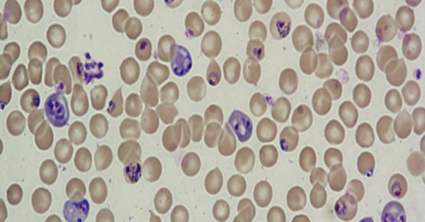 Red blood cells infected with malaria parasites (purple).