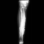 X-ray image of a patient’s limb showing the excess bone growth that occurs in melorheostosis, which resembles was from a dripping candle