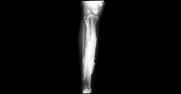 X-ray image of a patient’s limb showing the excess bone growth that occurs in melorheostosis, which resembles was from a dripping candle