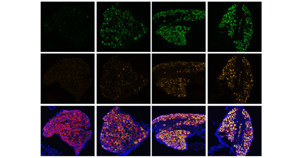 After an injury, neurons undergo genetic changes that are initiated by DLK and lead to pain and nerve damage. Over time (left to right), certain genes become more active (green = Atf3, orange = Csf1). 