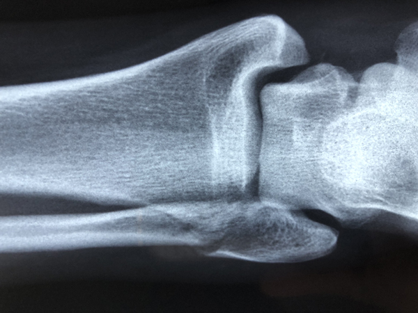 X-ray of human forearm showing elbow, top of radius and ulna