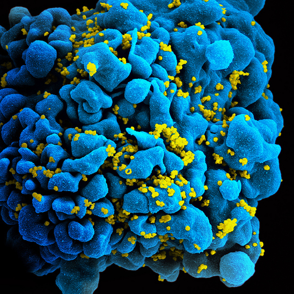 Scanning electromicrograph of an HIV-infected T cell.