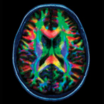 Color-coded brain scan.