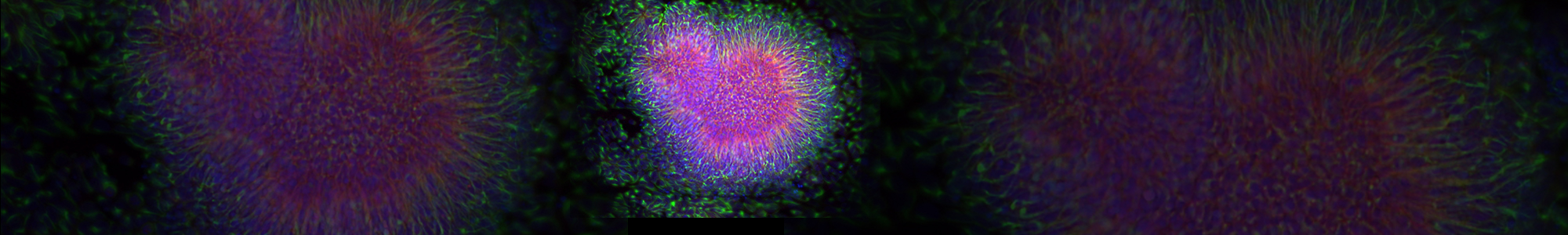 Immunofluorescence image of neuronal progenitor cells in an autistic patient.