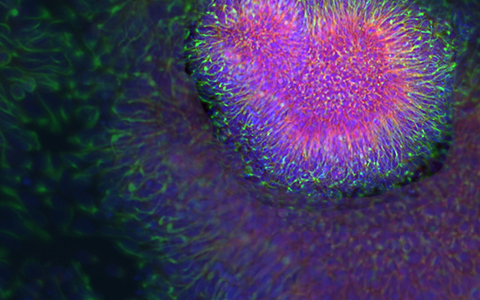 Immunofluorescence image of neuronal progenitor cells in an autistic patient.