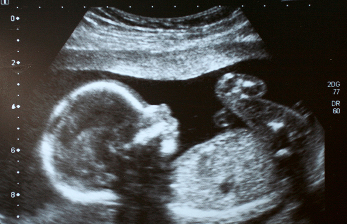 An ultrasound image scan of a human fetus.