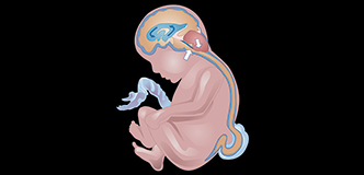 Side view of a fetus with a myelomeningocele protrusion in the lower spine