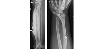 X-ray images of bones with traditional dripping candle wax form of melorheostosis and the form linked to mutations in the SMAD3 gene.