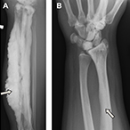 X-ray images of bones with traditional dripping candle wax form of melorheostosis and the form linked to mutations in the SMAD3 gene.