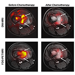 Before and after images showing similar results of MRI and PET scans after chemotherapy for a bone tumor.