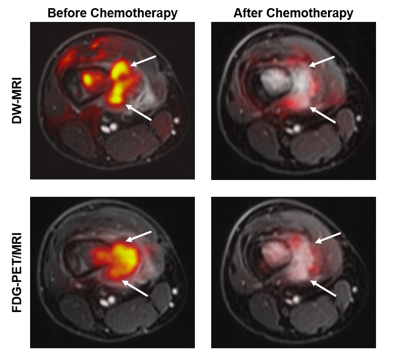 Before and after images showing similar results of MRI and PET scans after chemotherapy for a bone tumor.