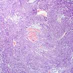 Photomicrograph of fibroid tissue.