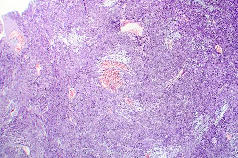 Photomicrograph of fibroid tissue.