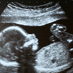 Ultrasound image of fetus.