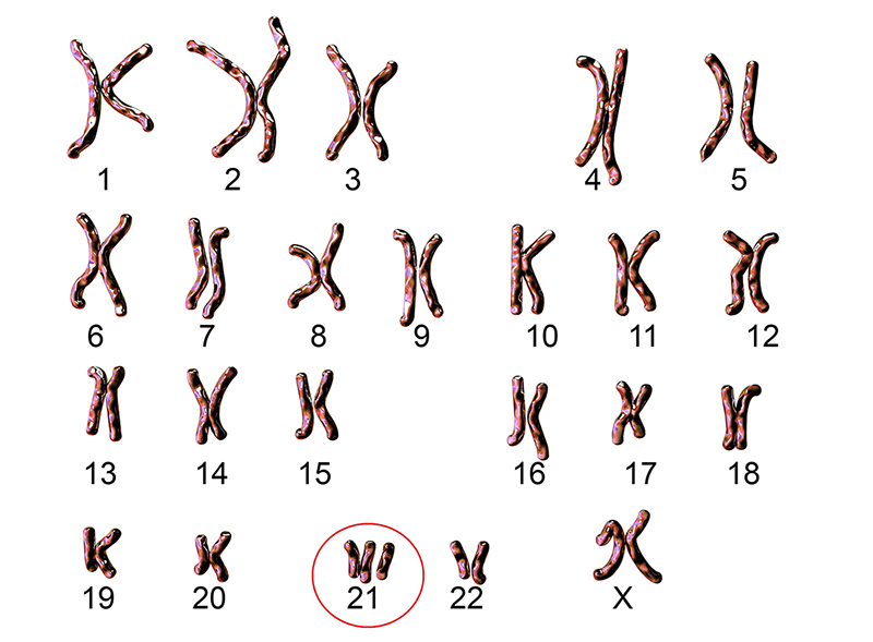 A chart of human chromosomes showing the extra 21st chromosome present in Down syndrome.