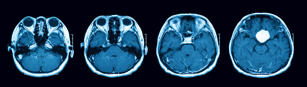 Magnetic resonance imaging scan of the brain showing pituitary mass.