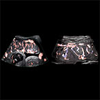 Two ultrasound images of the placenta with red and blue coloring to indicate blood flow appear side by side against a black background.