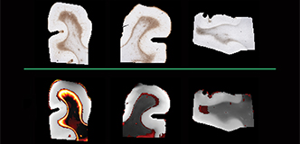 The upper panel, labeled “histology,” shows three brain sections with brown areas indicating astrogliosis. Below a green line, the lower panel, labeled “multidimensional MRI,” shows the same three brain sections with yellow-to-red areas indicating astrogliosis. A scale bar appears on the right.