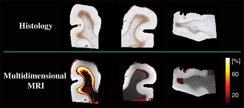 The upper panel, labeled “histology,” shows three brain sections with brown areas indicating astrogliosis. Below a green line, the lower panel, labeled “multidimensional MRI,” shows the same three brain sections with yellow-to-red areas indicating astrogliosis. A scale bar appears on the right.