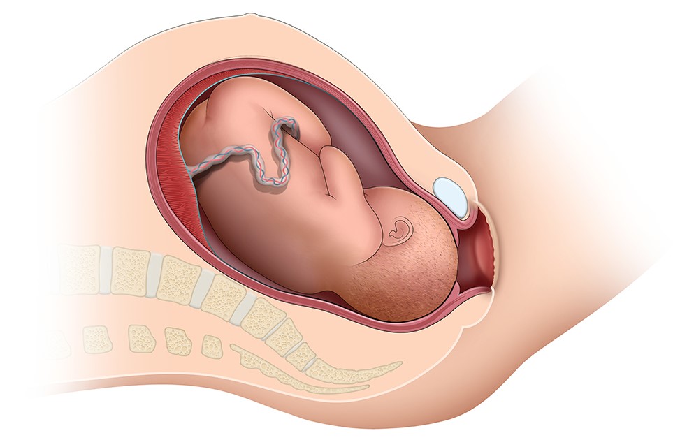 Cutaway graphic of the fetus in the womb entering the birth canal