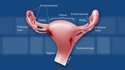 Graphic of female reproductive organs with endometriosis lesions.