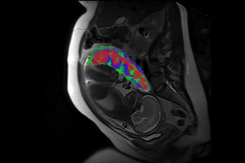 A cross-section of the pregnant person and fetus are visible in black and white. The placenta is shown at the top of the uterus in red, green, and blue.