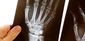 An x-ray image of a hand is held up by another person’s hand.