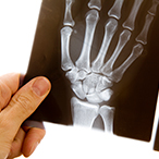 An x-ray image of a hand is held up by another person’s hand.