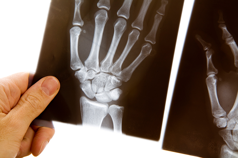 An x-ray image of a hand is held up by another person’s hand.