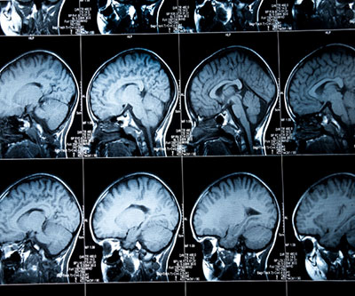 A series of brain scans are shown in front of a light box.
