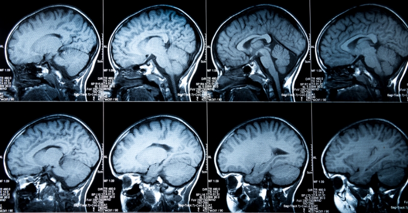 MRI brain scans against a lightbox.