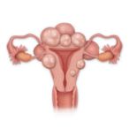 Graphic of a uterus with fibroids.