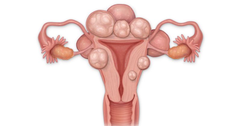 Graphic of a uterus with fibroids.