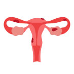 Illustration of a uterus with endometriosis lesions.