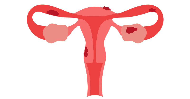 Illustration of a uterus with endometriosis lesions.