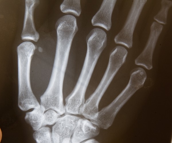 X-rays of hand and wrist bones are held against a light box.