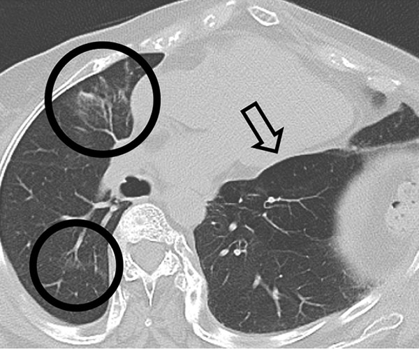 Black-and-white photo of a chest computed tomography scan. Two black circles and a black arrow indicate atypical features.