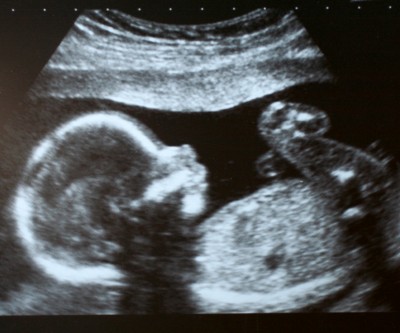 A black and white ultrasound of a fetus in profile.