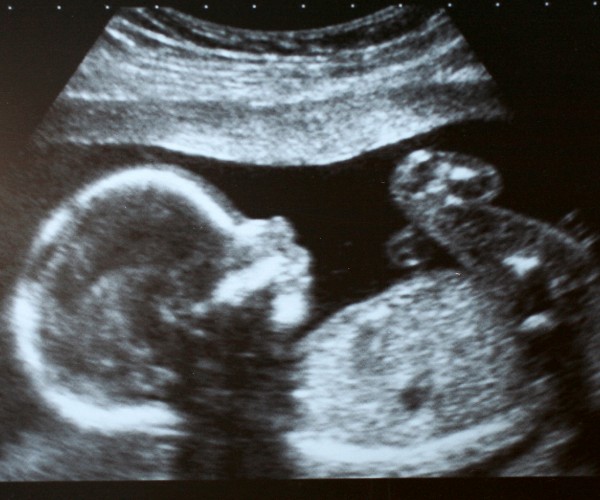 A black and white ultrasound of a fetus in profile.