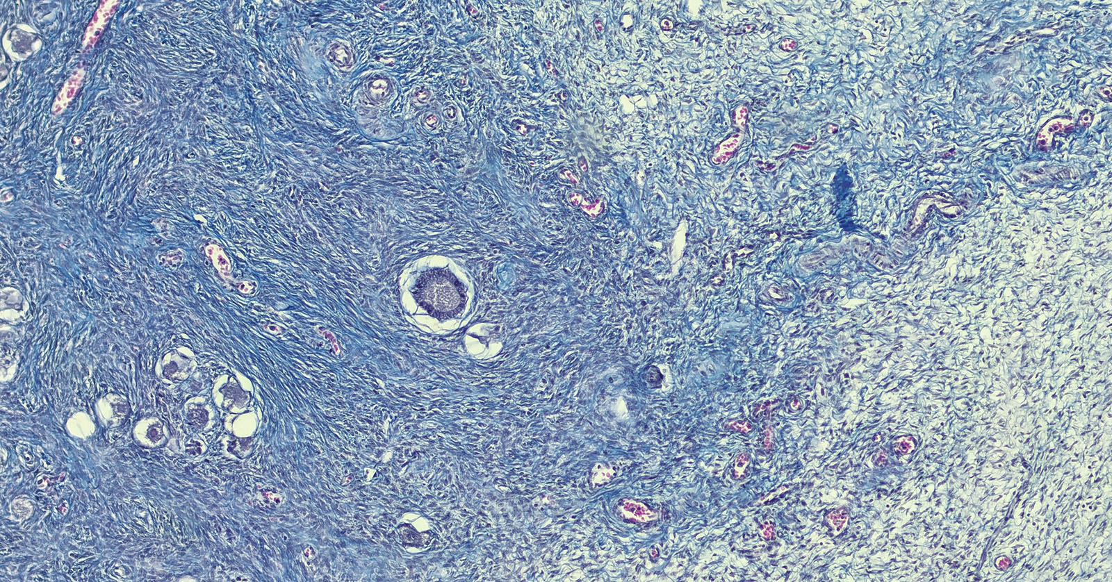 Fibroids in uterine muscle tissue.